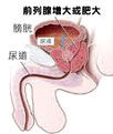 惹上前列腺肥大该怎样进行保健