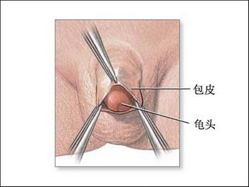 假性包皮过长会给男人造成哪些危害