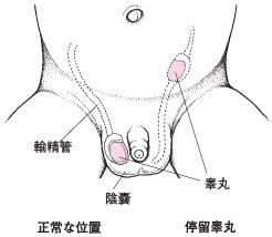 患睾丸炎有什么现象呢？