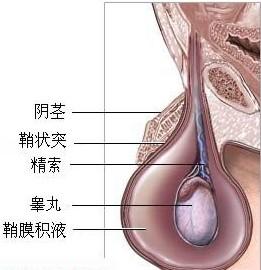 谁唤醒了鞘膜积液