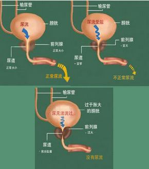 为何前列腺增生呈现年轻化?