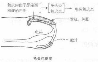 让包皮龟头炎发生的原因有哪些?