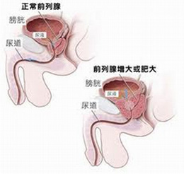 前列腺增生不治会引起哪些并发症?