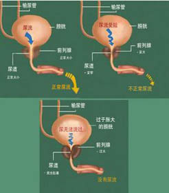 前列腺增生的危害主要有哪些?