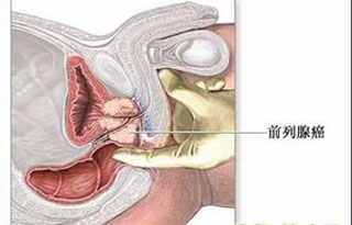 前列腺癌在早期有哪些症状表现?