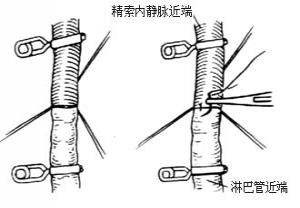 精索静脉曲张影响男性精子吗?