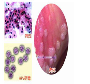 尖锐湿疣的误区有哪些呢?
