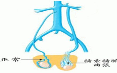 精索静脉曲张的不良后果有哪些?