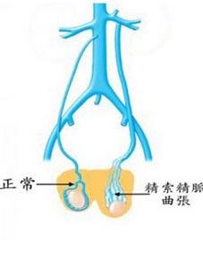 精索静脉曲张会给男性带去什么危害?