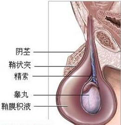 鞘膜积液术后护理