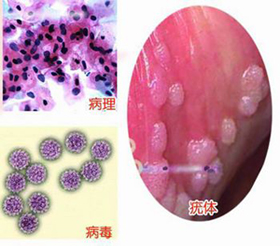 尖锐湿疣会有哪些症状表现