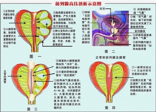 ZRL高压透析术治疗前列腺疾病